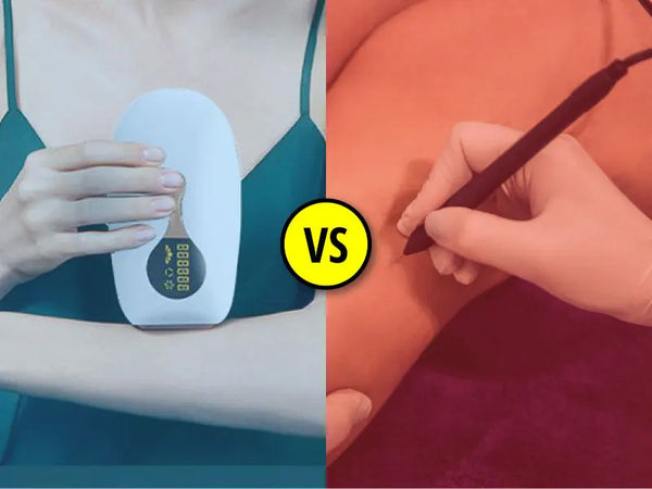 Laser hair removal vs. electrolysis